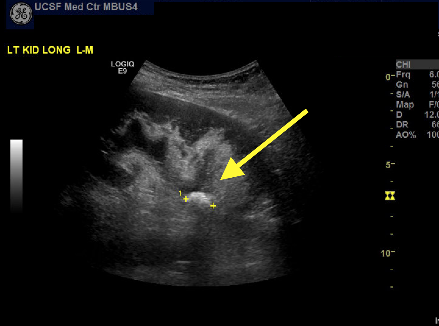 kidney-stone-ultrasound